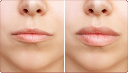 22133-lip-fillers-1177813558 1